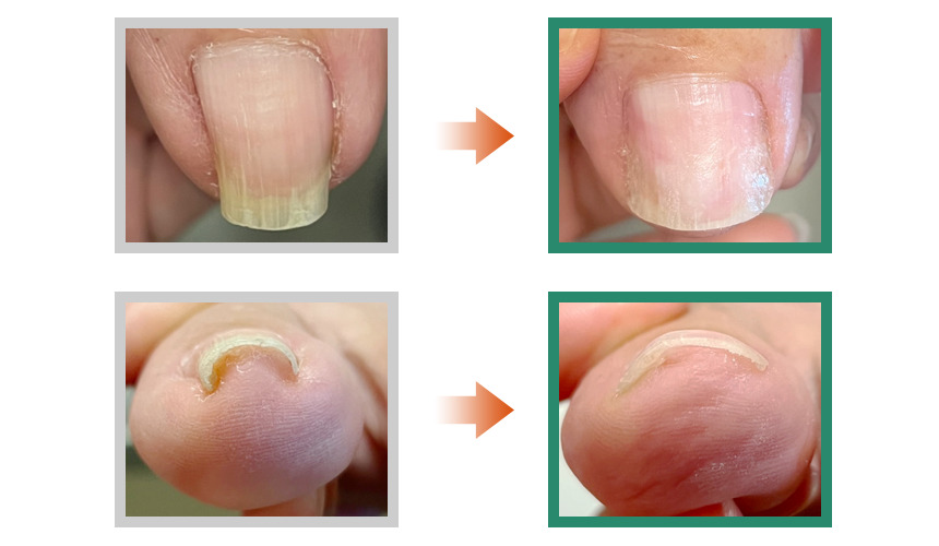 巻き爪,広島,佐伯区,陥入爪