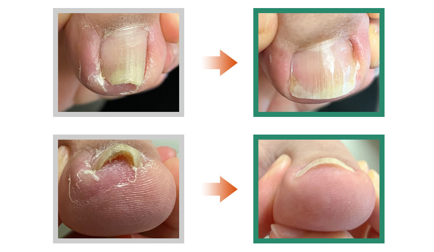 巻き爪,広島,佐伯区,陥入爪